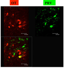 C_Imm_Con_HG_1_1.jpg Figure 1: Double immunofluorescent labelling showing the brain neurons projecting to the vagina and the clitoris (evidenced by the retrograde tracer PRV injected in these organs) and expressing oxytocin (OT).(From Gelez, H. et al. ESSM/ISSM conference; 2008). 