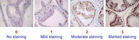 C_Imm_His_AO_1_1.jpg Figure 1: Representative images of semi-quantitative scoring of immunostaining (PCNA) in rat prostate sections depending on intensity of the staining (pelvipharm internal data).