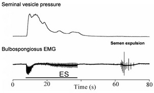 Figure 1:Example of seminal vesicle pressure and bulbospongiosus muscle electromyogram (EMG) responses following electrical stimulation (ES) of the intermesenteric nerves (Pelvipharm, internal data). 